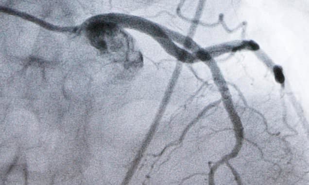 New Cholesterol Pill Rivals Injections