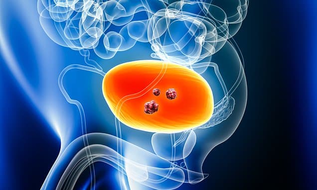 Bladder Cancer Survival Boosted by New Treatment