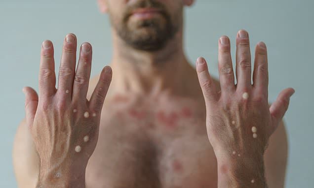 New Mpox Strain Merges Deadly Clades in UK