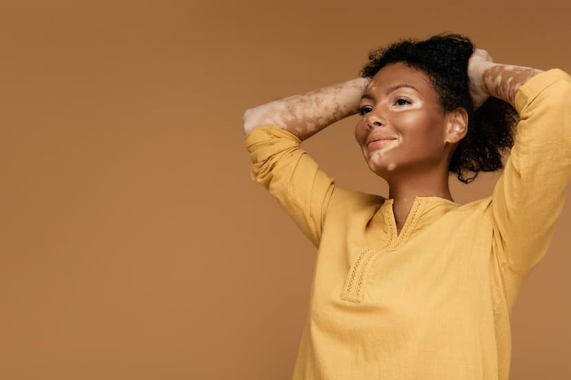 New Hope for 80,000 England Vitiligo Sufferers