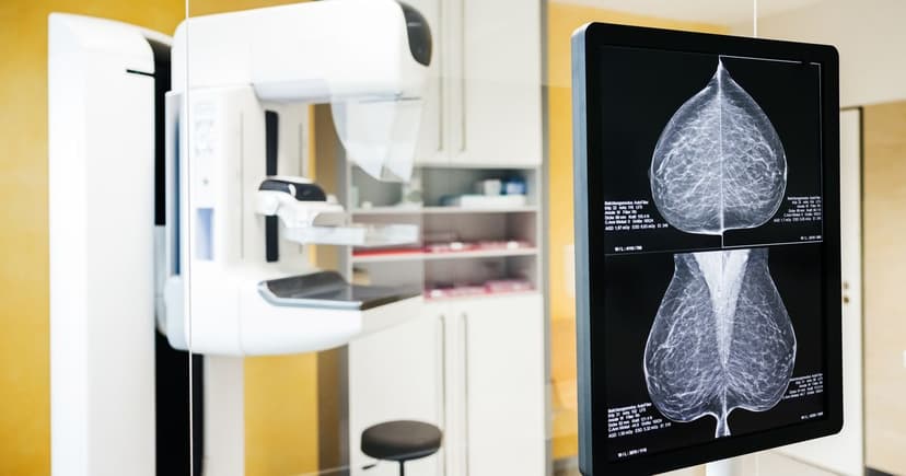 NHS Breast Screening: Early Detection Saves Lives