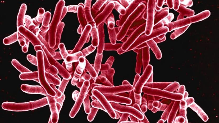 NJ Resident Tests Positive for TB