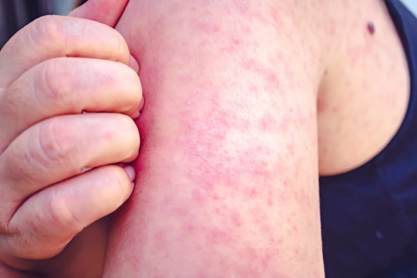 North Dakota Measles Surge: 11 Cases Erupt