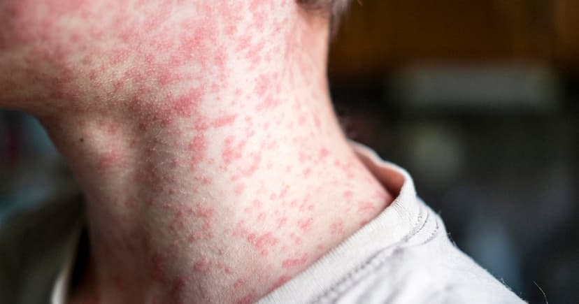 NY Declares Measles Emergency: Vaccinations Ramp Up