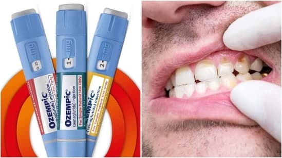 Ozempic's Hidden Toll: Your Smile at Risk?