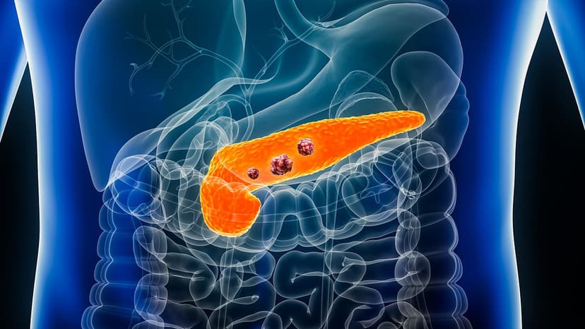 Breakthrough Drug Shows Promise Against Pancreatic Cancer