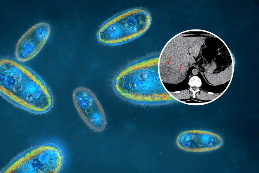 Parasite's bizarre journey from lice to liver infection