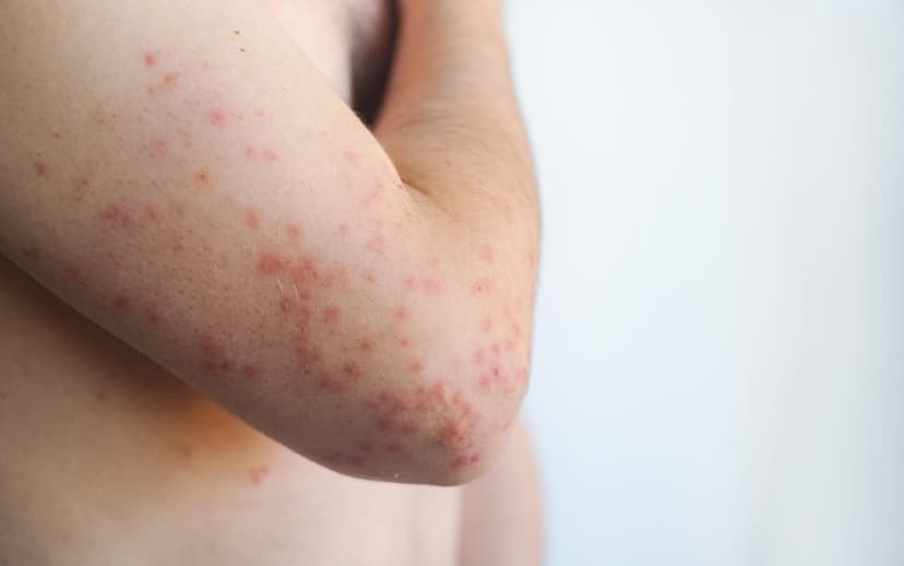 PA Measles Deaths Hit 5 Amid Reporting Dispute