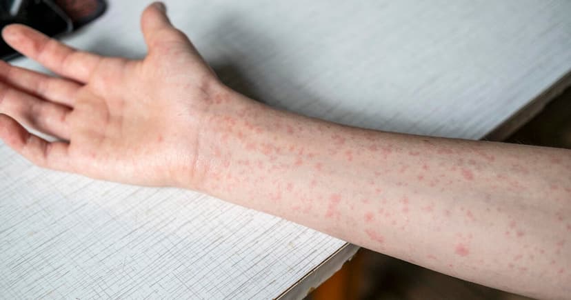 Measles Outbreak Hits Pittsburgh: First Case Since 2019