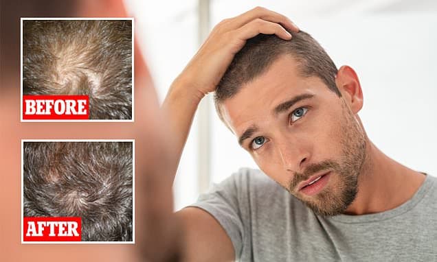 Hair Loss Solution: Lunch Break Procedure Offers Hope