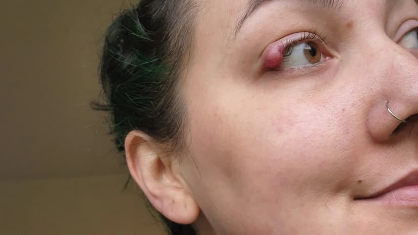 Eyelid Lump: Rare Cancer Diagnosis Surprise