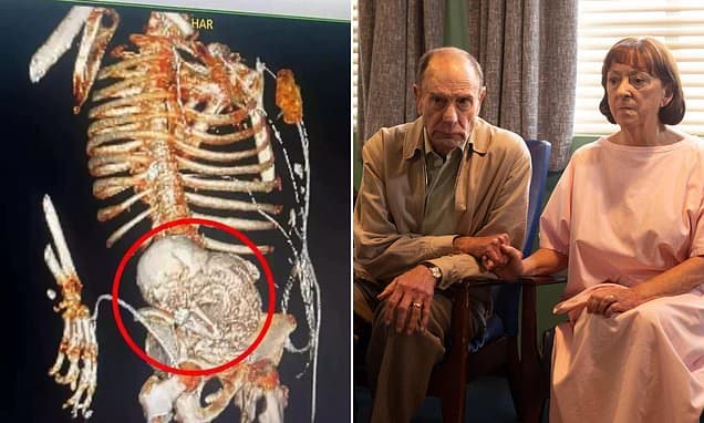 Rare 'Stone Baby' Pregnancy Stuns TV Drama Audience