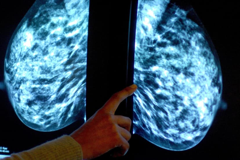 Roche Drug Slashes Breast Cancer Recurrence by 30%