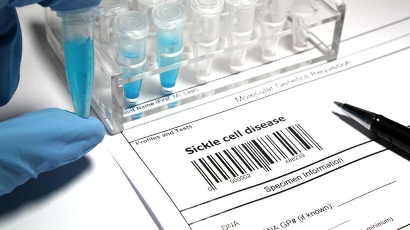 Sickle Cell: Medical Reports Trump Horoscopes in Odisha