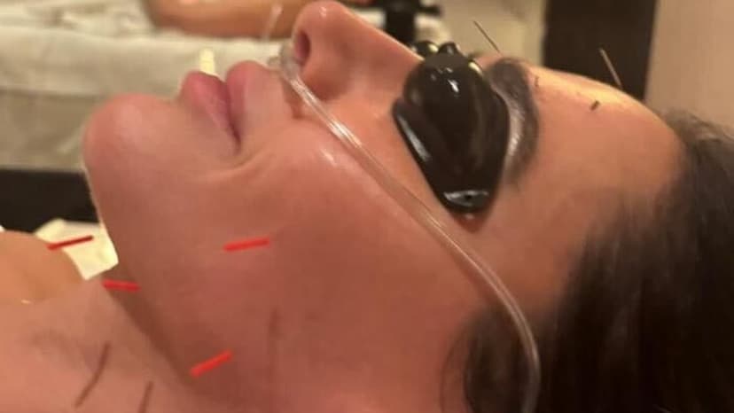 Simon Cowell's Needle Facial: Extreme Anti-Aging Revealed