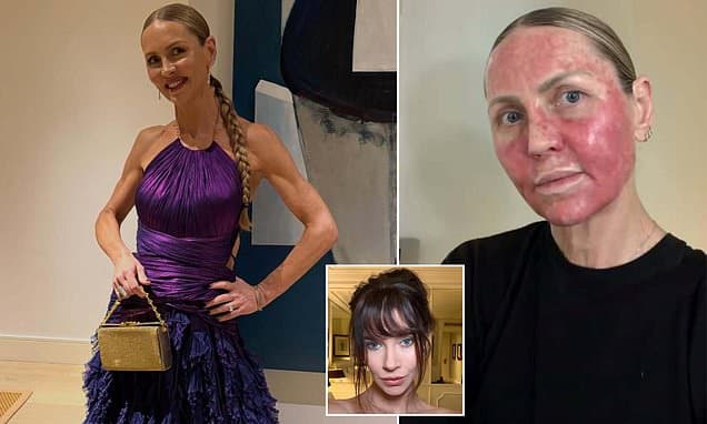 Skin Cancer Horror: Face Blistered Raw for Weeks