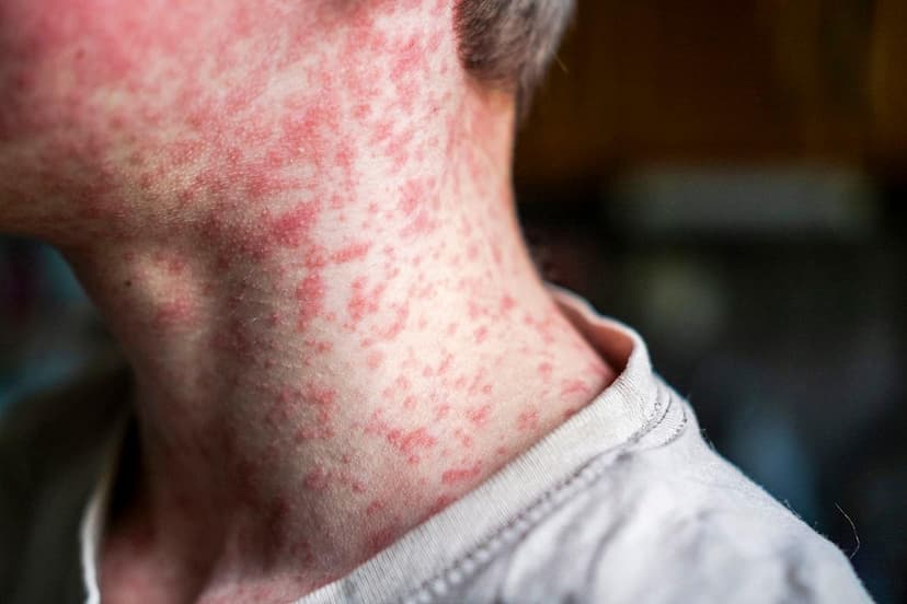 SC Measles Outbreak Accelerates: Hundreds Quarantined