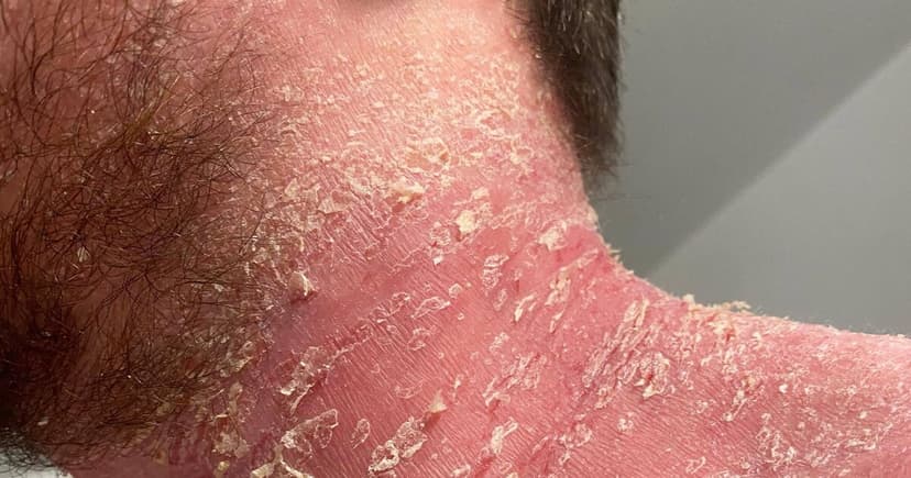 Steroid Cream Overuse Devastates Electrician's Life