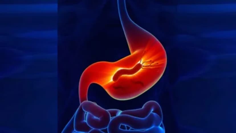 Stomach Cancer Masquerades as Ovarian Tumors