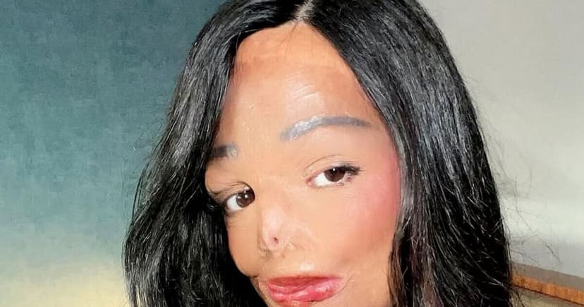 Girl's hair fire: A journey from tragedy to triumph