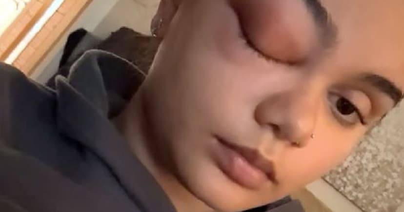 Teen's Cold Leads to Brain Surgery After Eye Infection