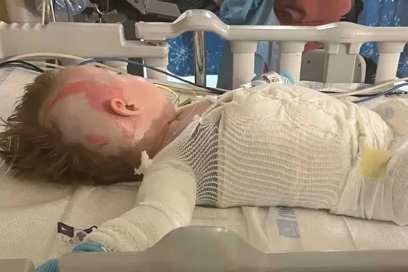 Toddler Severely Burned by Kitchen Appliance