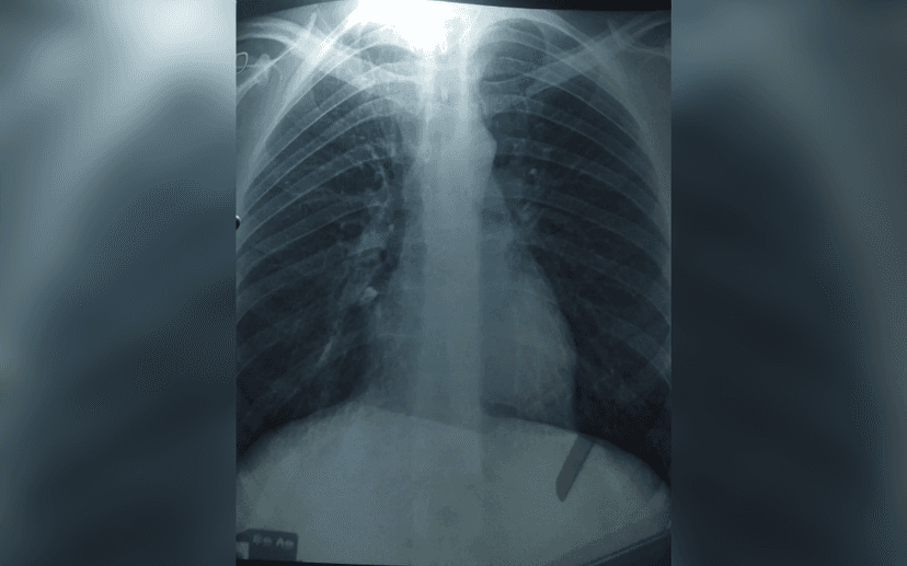 Sedated Surgery Mishap: Tooth Found in Man's Lung