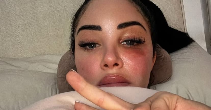 Tulisa Shares Bell's Palsy Battle After Friend's Cancer News