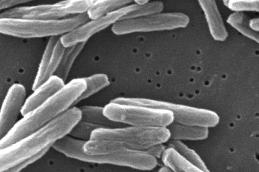 TB Outbreaks Surge: US Faces Persistent Transmission Risks