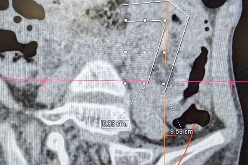 Vietnam Girl's Hairball Emergency: A Meter-Long Mass Removed