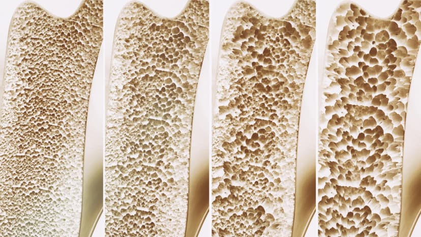 Calcium & Vitamin D: No Fracture Prevention?