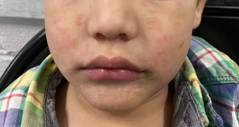 Wellington High Reports Second Measles Case