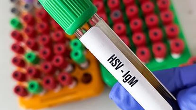 Jalpaiguri Prison Overcrowding Fuels Deadly Herpes Virus