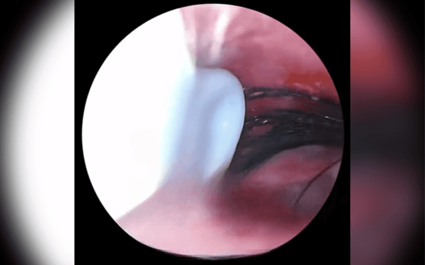 Eyelash Near Eardrum: Woman's Shocking Discovery