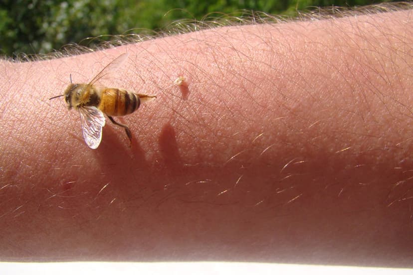 Lyme Disease Patient Stings Herself With Bees