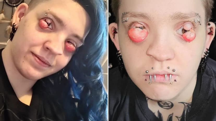 Eye Cysts Cause Blindness & Unimaginable Pain