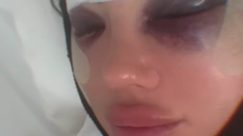 Yazmin Oukhellou's Painful Facelift: Bruises and Bandages Revealed